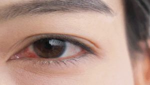 جلوگیری از خشکی چشم هنگام پوشیدن لنزهای تماسی